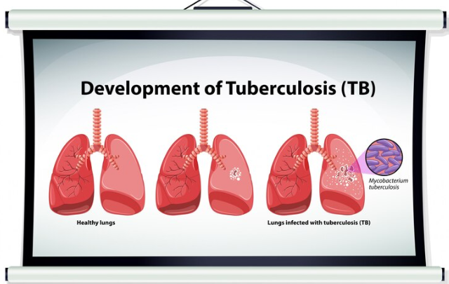 Systolic Murmur ICD-10